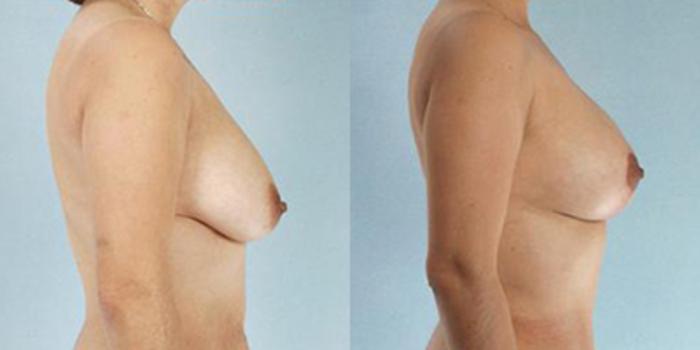 Before & After Breast Lift Case 4988 View 3 View in Houston, TX