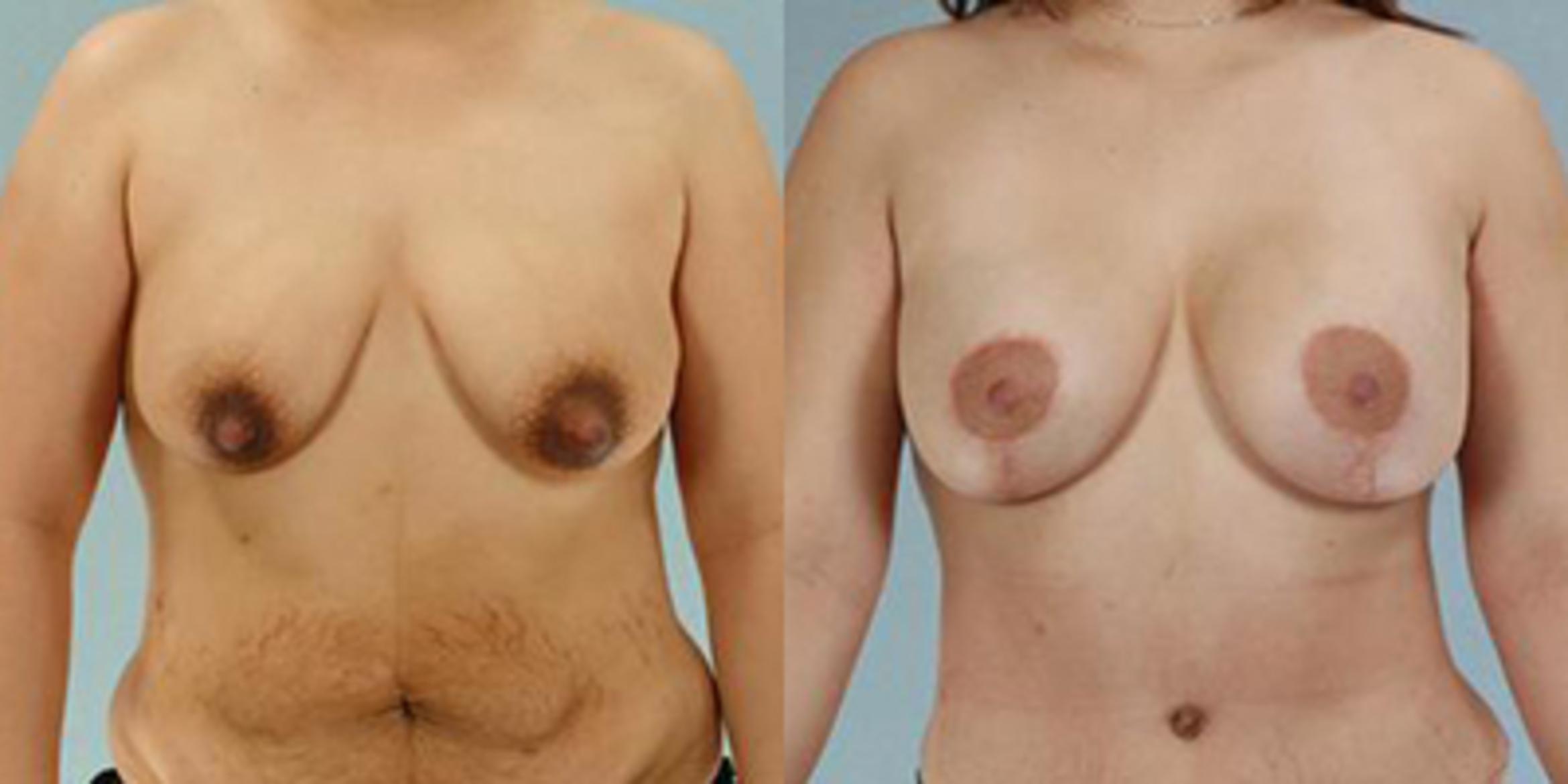 Before & After Breast Lift Case 4996 View 1 View in Houston, TX