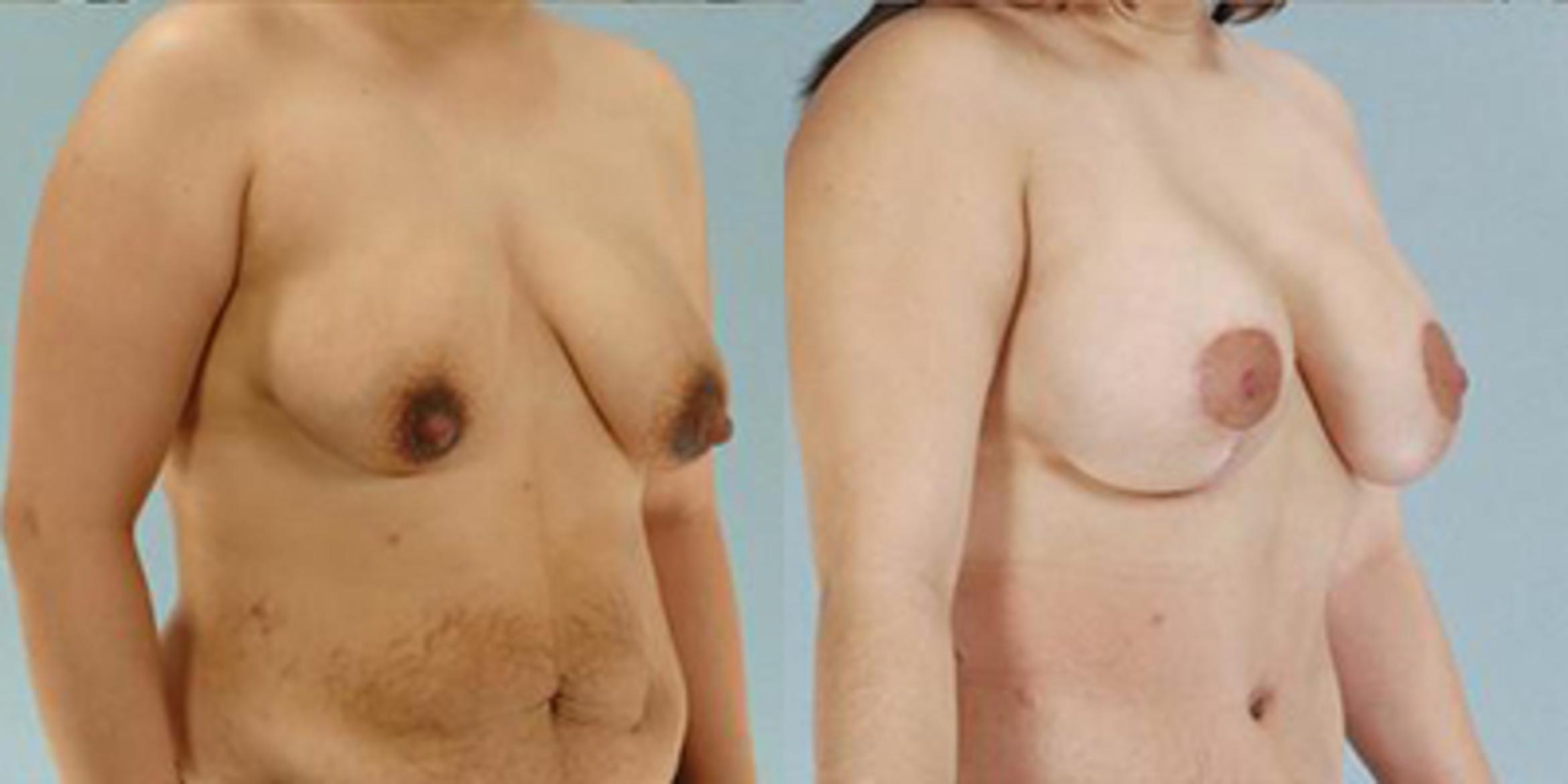 Before & After Breast Lift Case 4996 View 2 View in Houston, TX