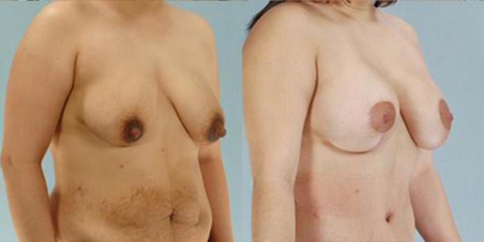 Before & After Breast Lift Case 4996 View 2 View in Houston, TX
