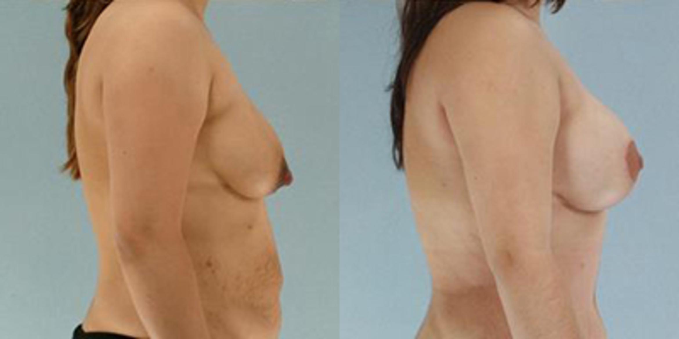 Before & After Breast Lift Case 4996 View 3 View in Houston, TX