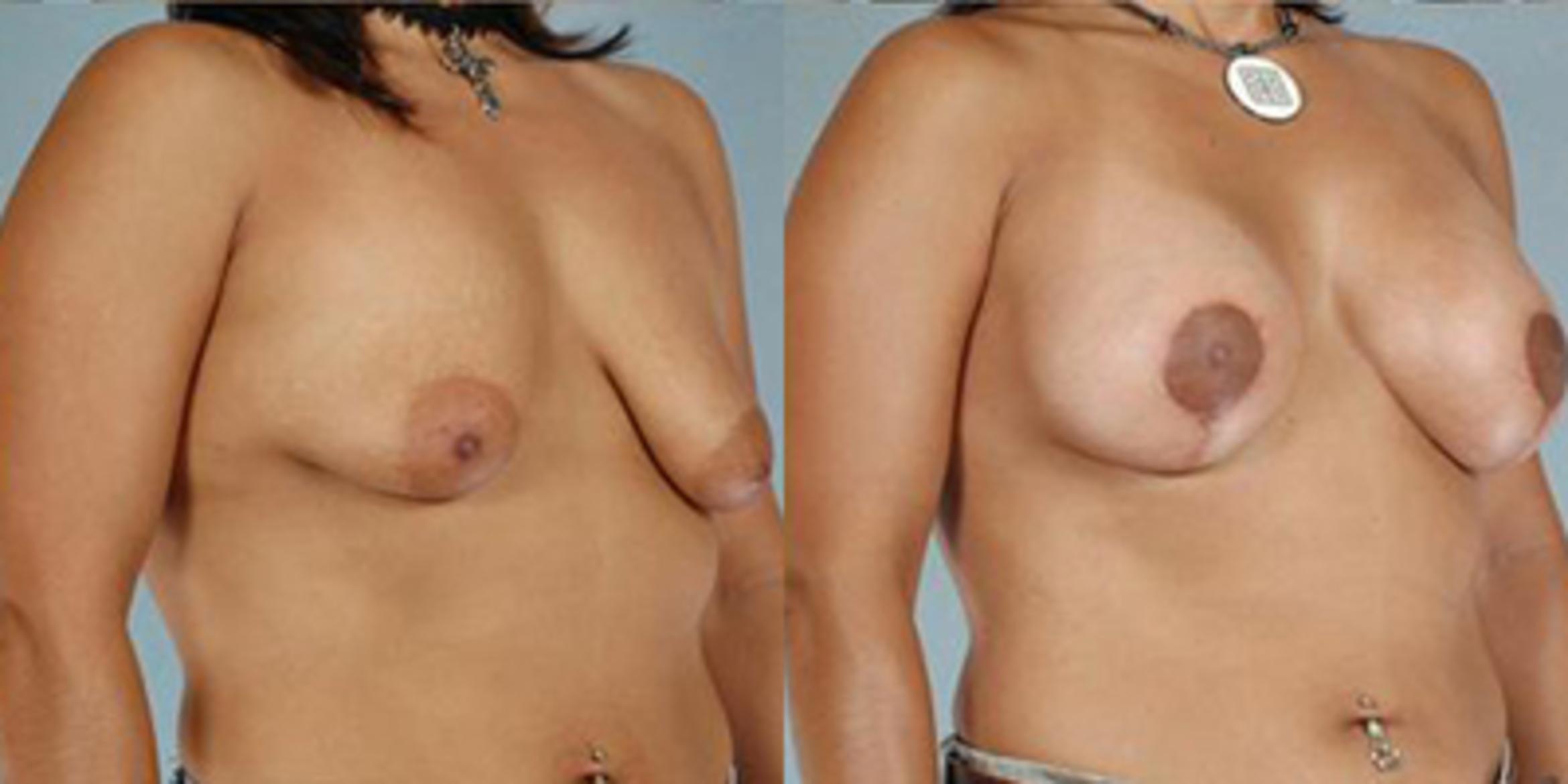 Before & After Breast Lift Case 5004 View 2 View in Houston, TX