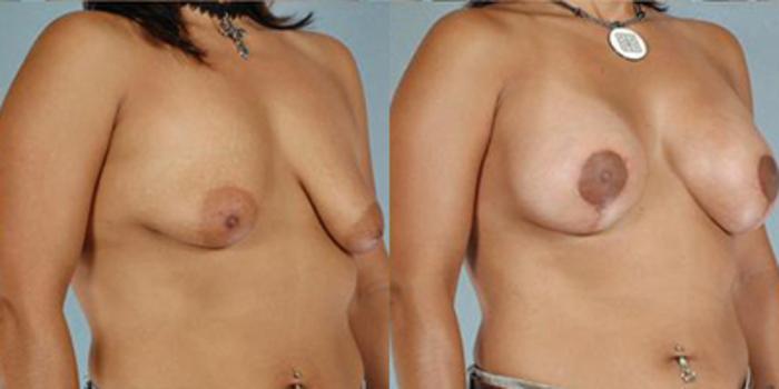 Before & After Breast Lift Case 5004 View 2 View in Houston, TX