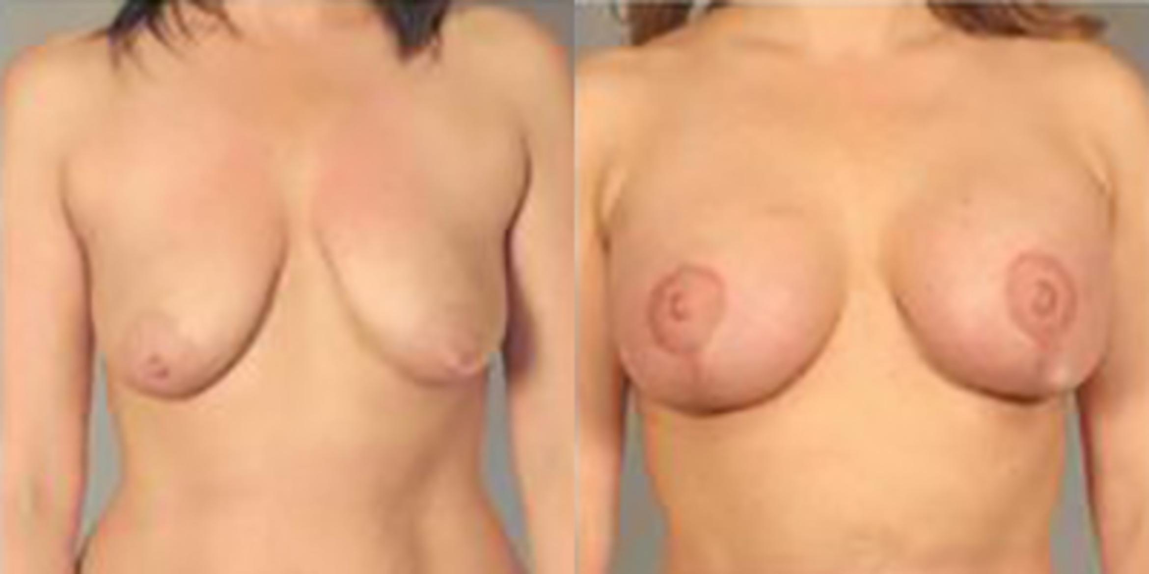 Before & After Breast Lift Case 5012 View 1 View in Houston, TX