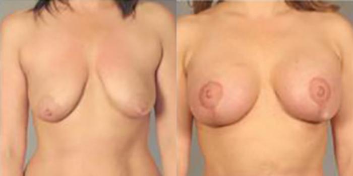 Before & After Breast Lift Case 5012 View 1 View in Houston, TX