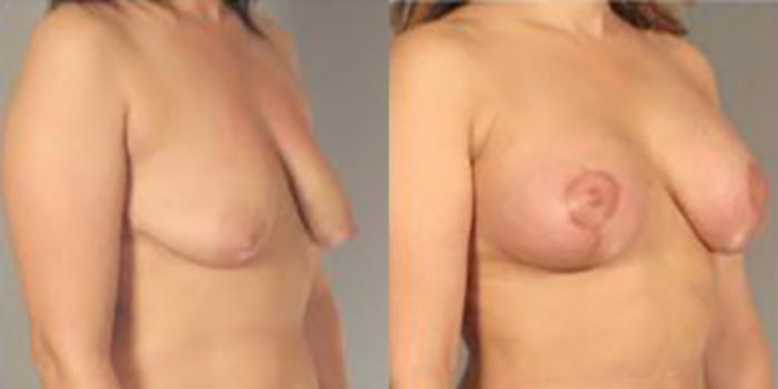 Before & After Breast Lift Case 5012 View 2 View in Houston, TX