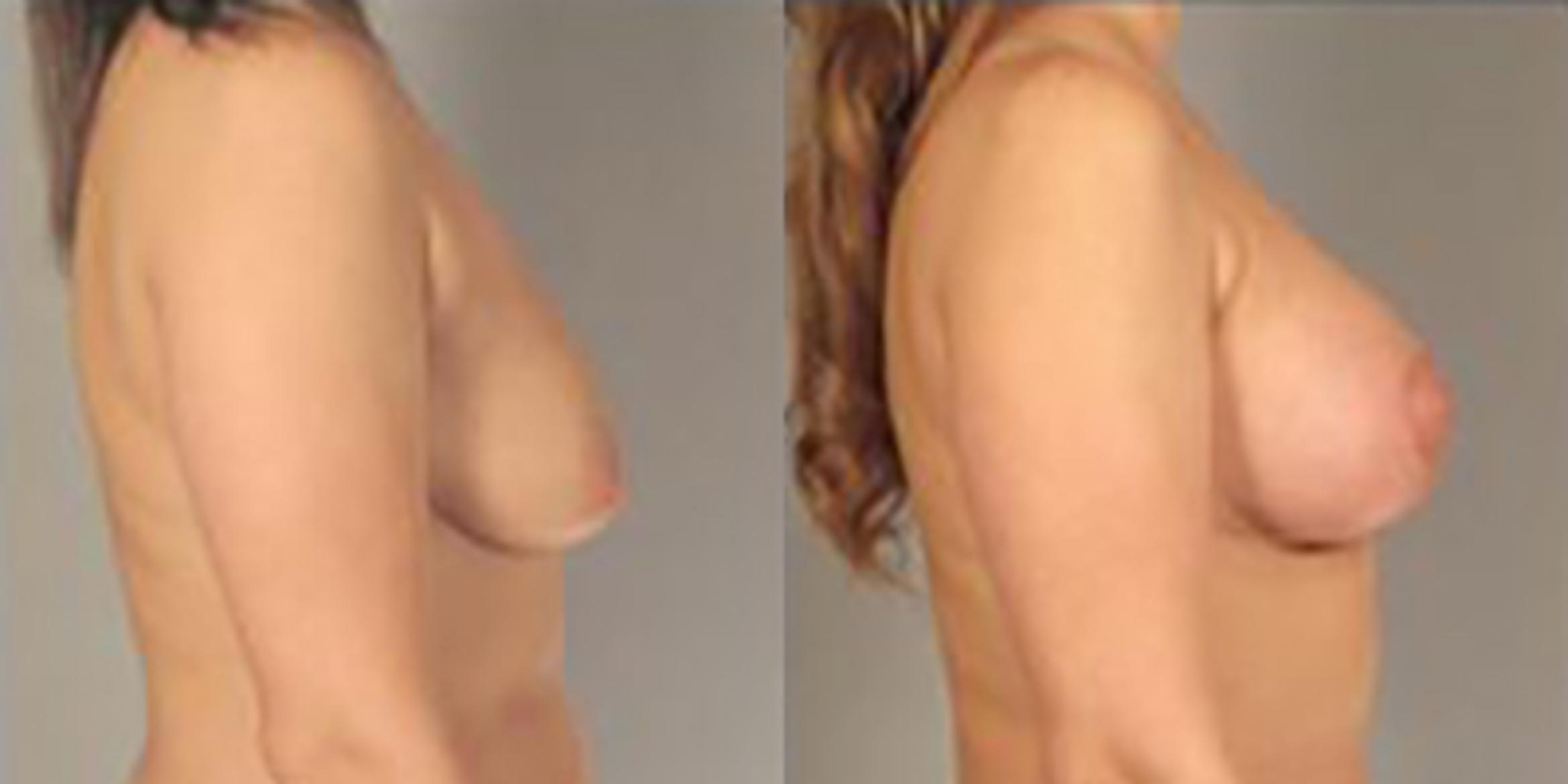 Before & After Breast Lift Case 5012 View 3 View in Houston, TX