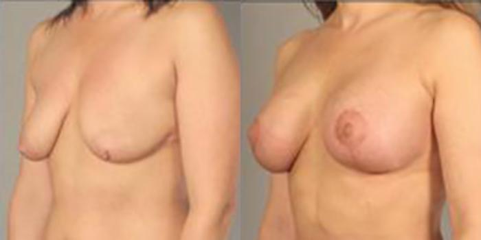 Before & After Breast Lift Case 5012 View 4 View in Houston, TX