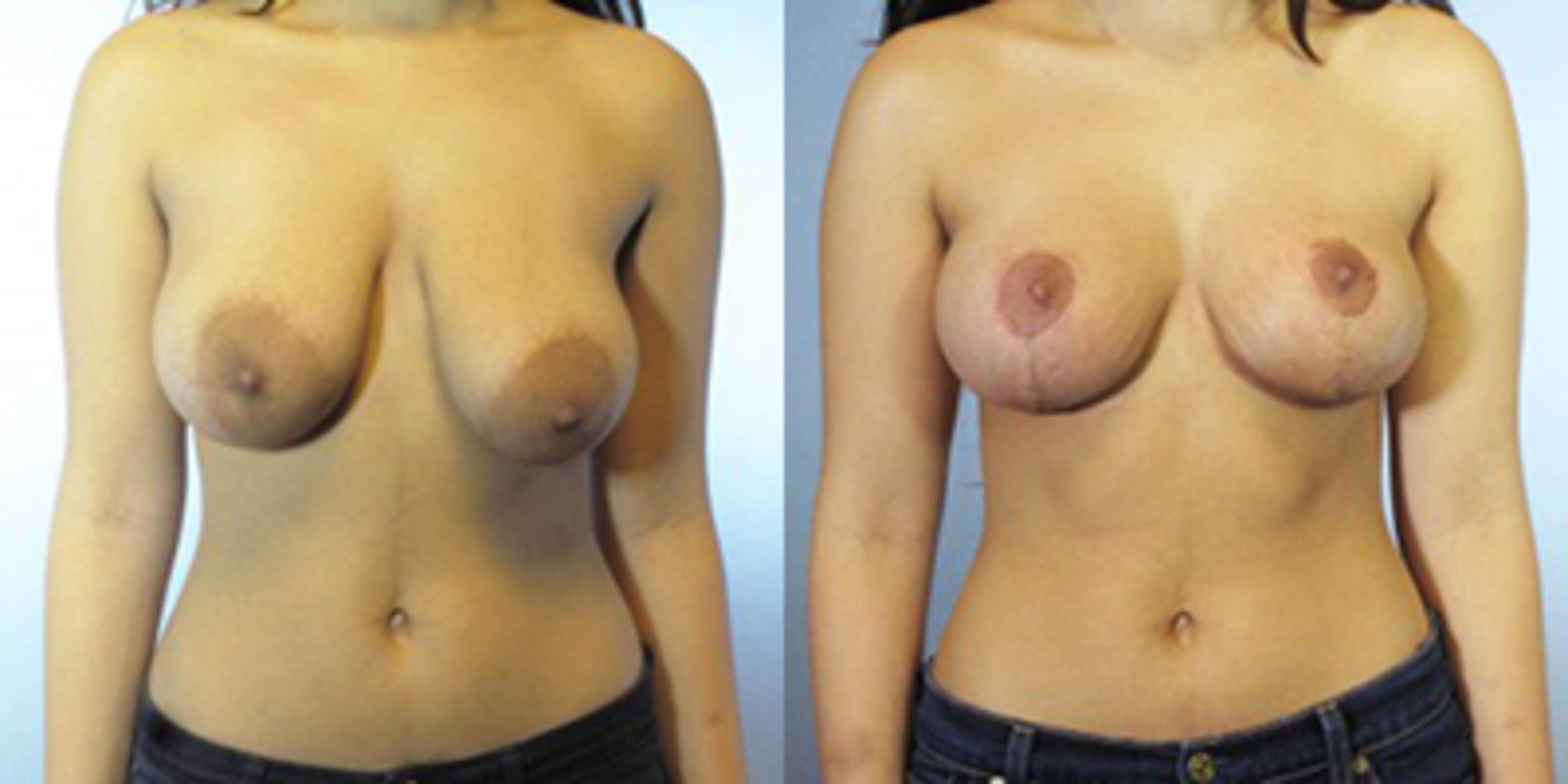 Before & After Breast Lift Case 8690 View 1 View in Houston, TX