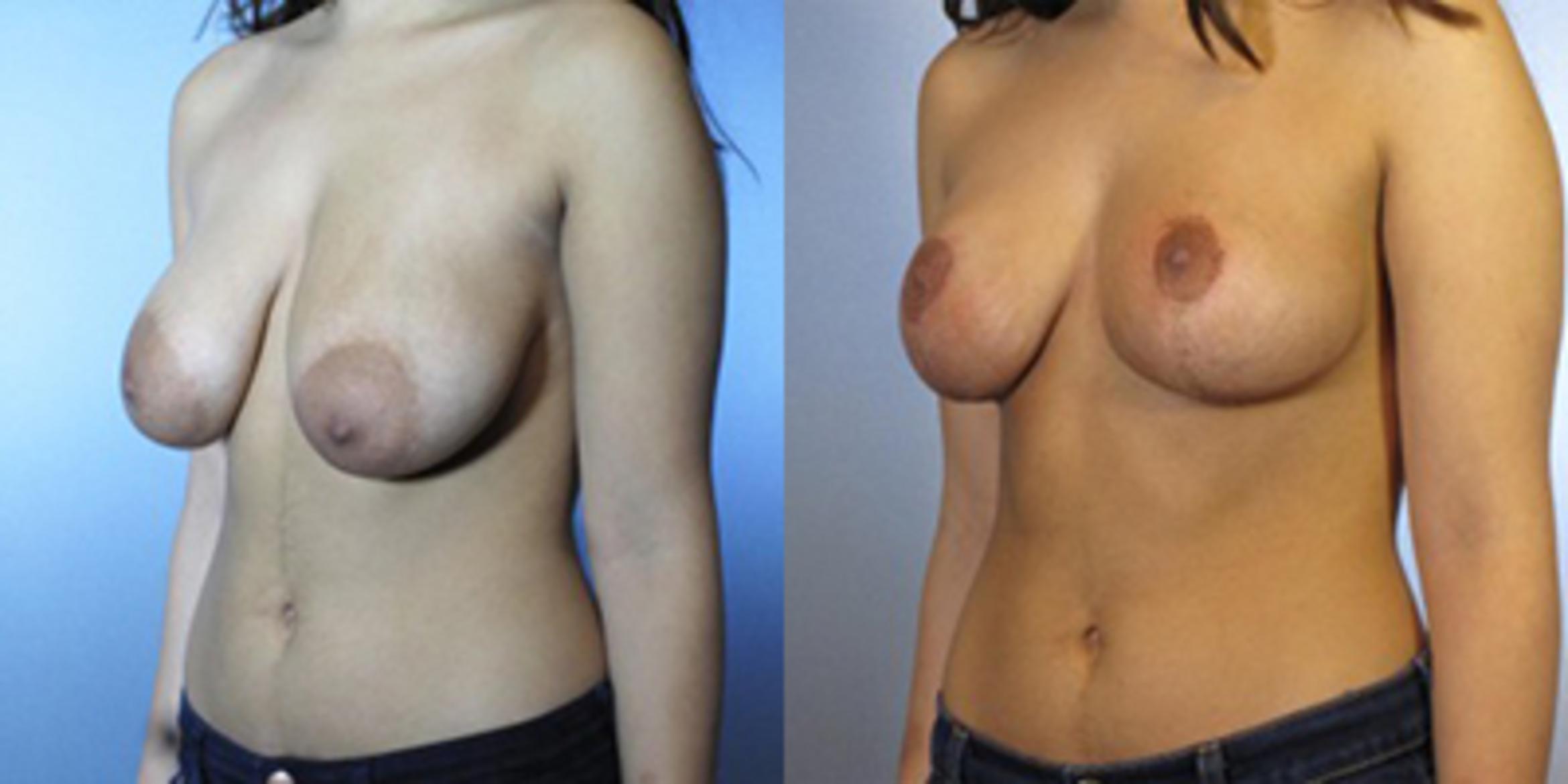 Before & After Breast Lift Case 8690 View 2 View in Houston, TX