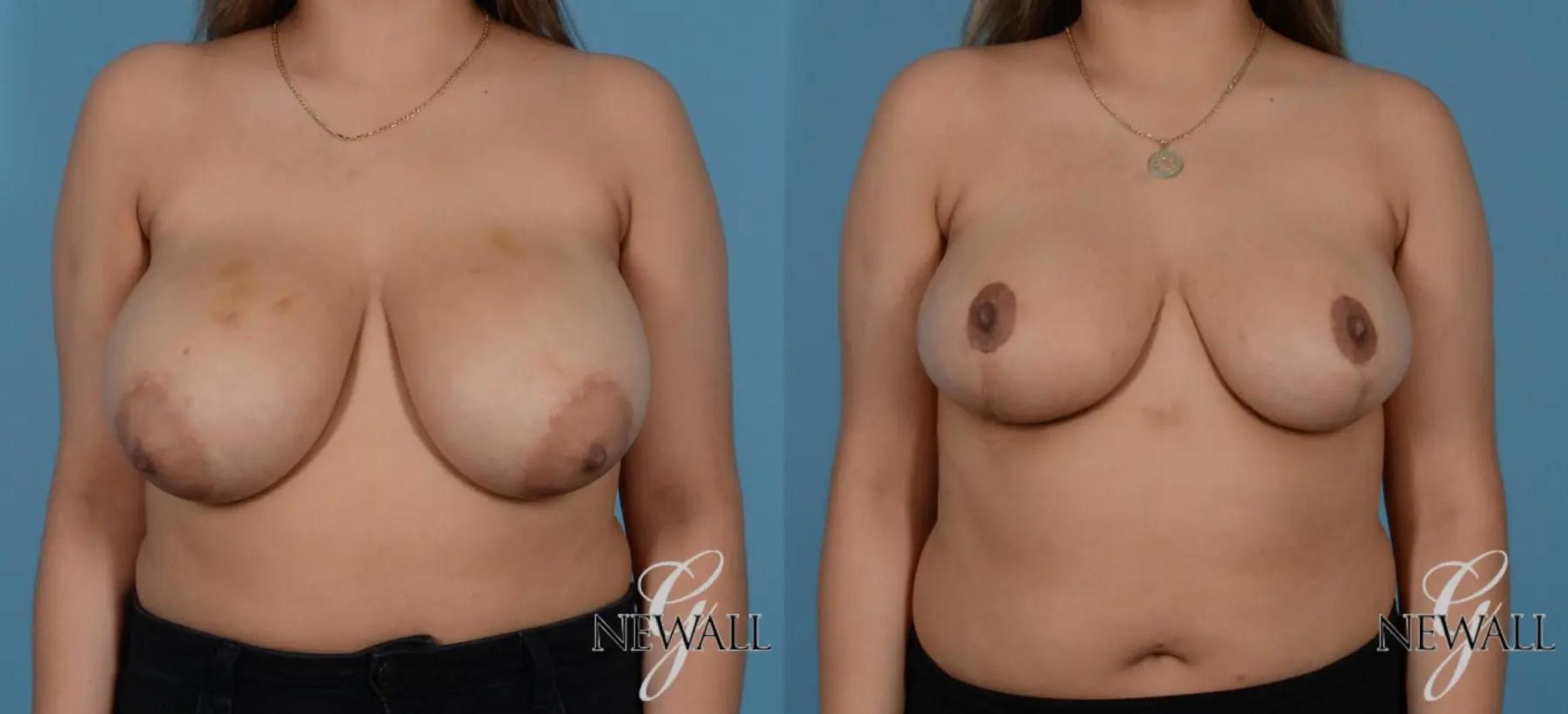 Before & After Breast Reduction Case 16990 View 1 View in Houston, TX