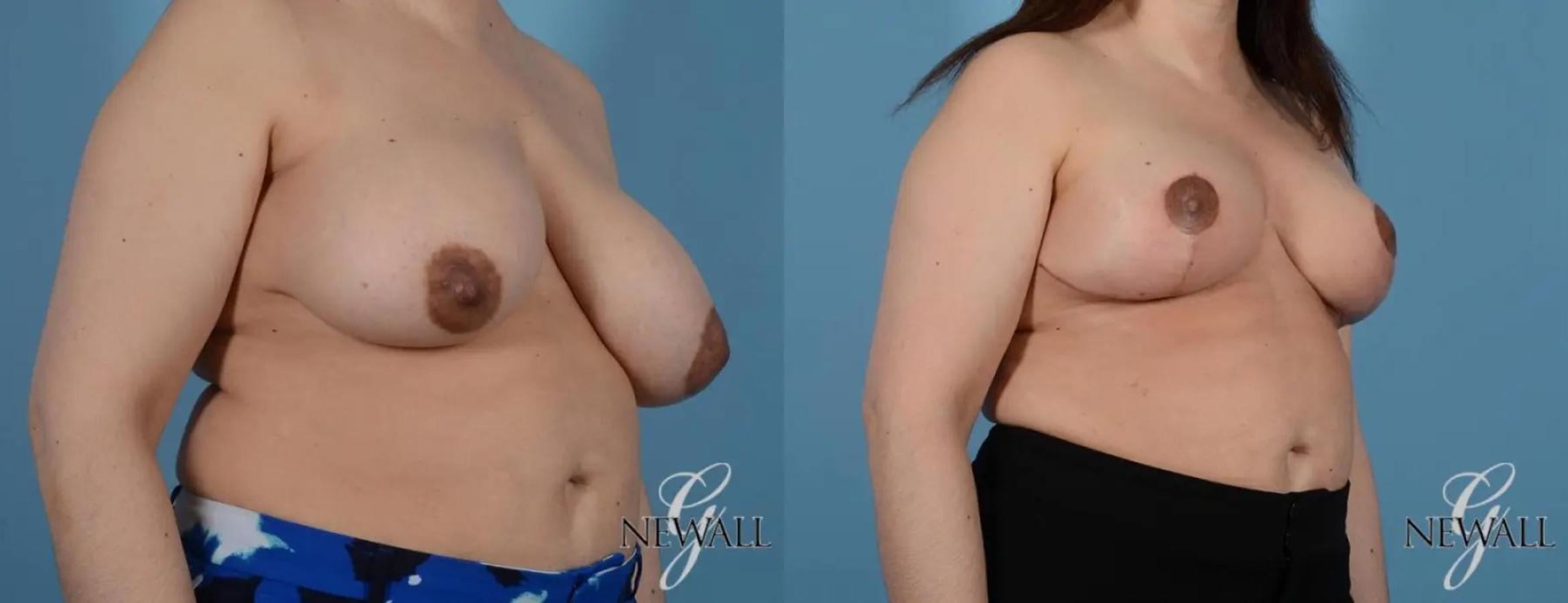 Before & After Breast Reduction Case 16998 View 2 View in Houston, TX