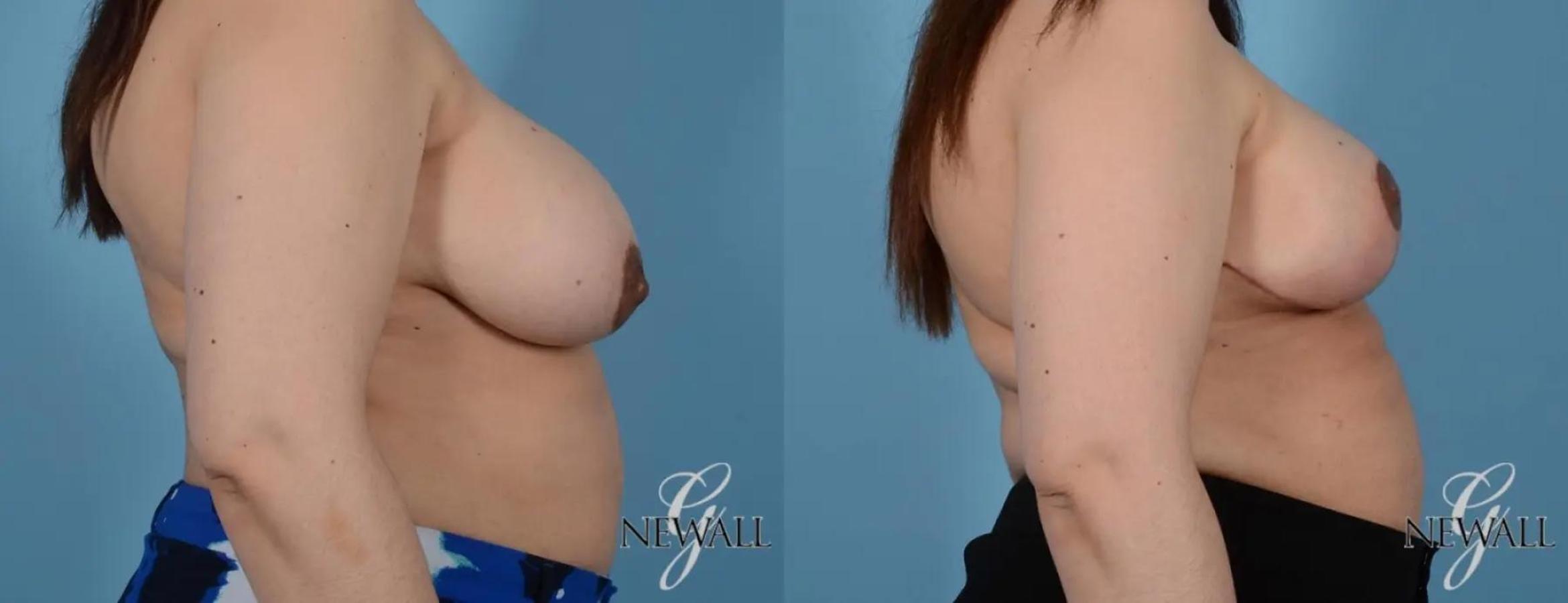 Before & After Breast Reduction Case 16998 View 3 View in Houston, TX