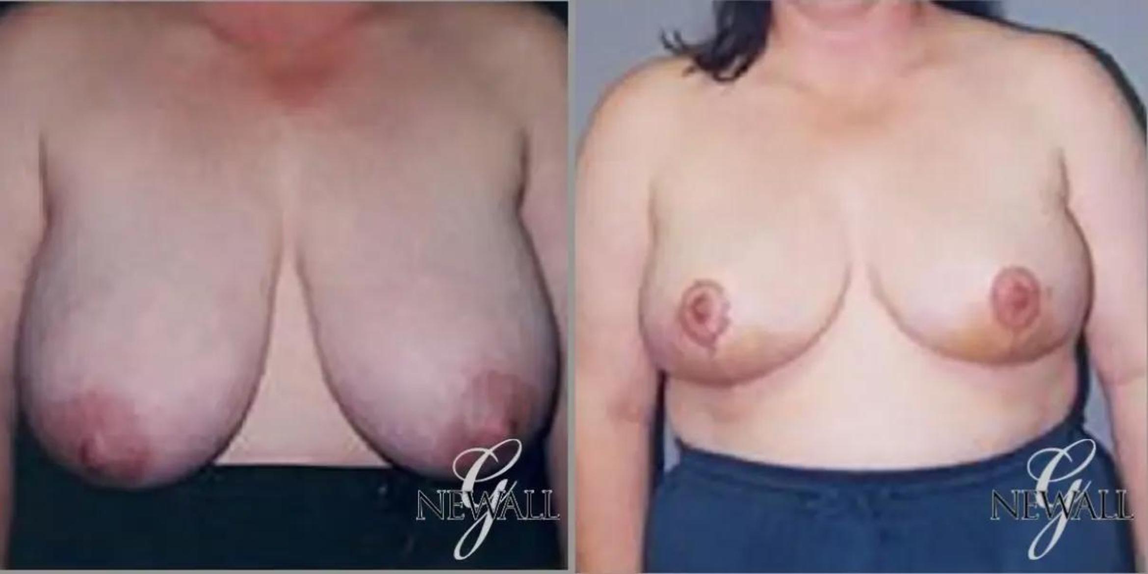 Before & After Breast Reduction Case 17779 View 1 View in Houston, TX