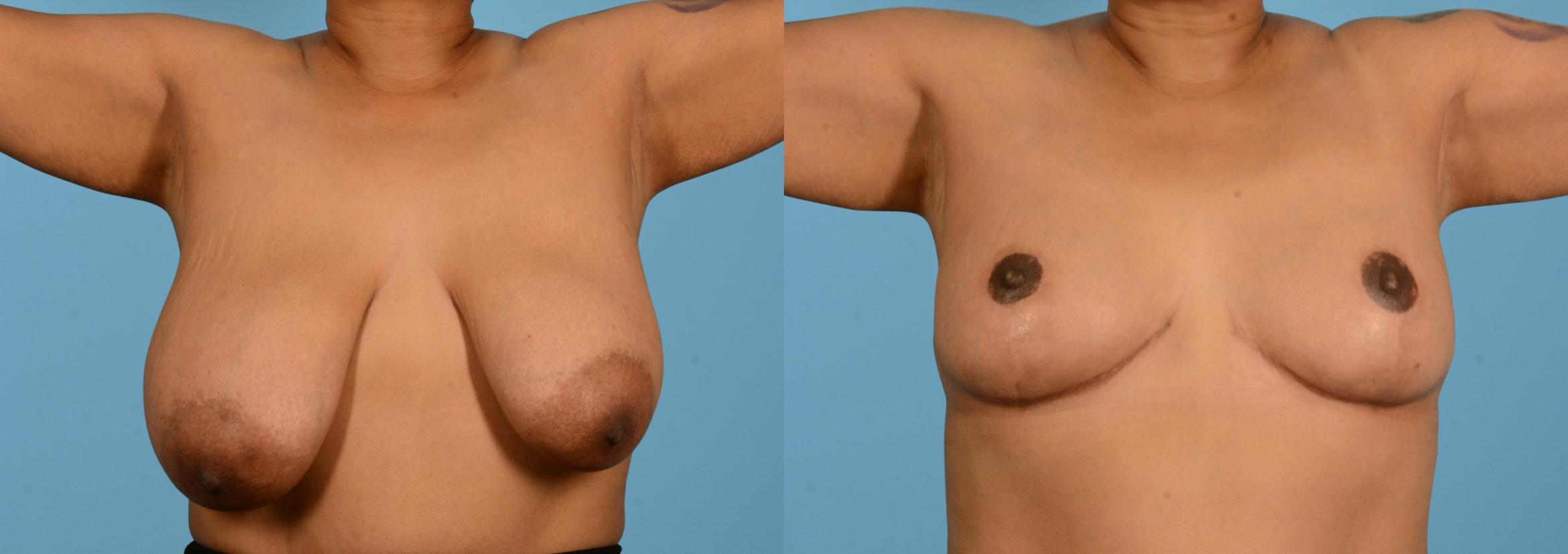 Before & After Breast Lift Case 18135 Front View in Houston, TX