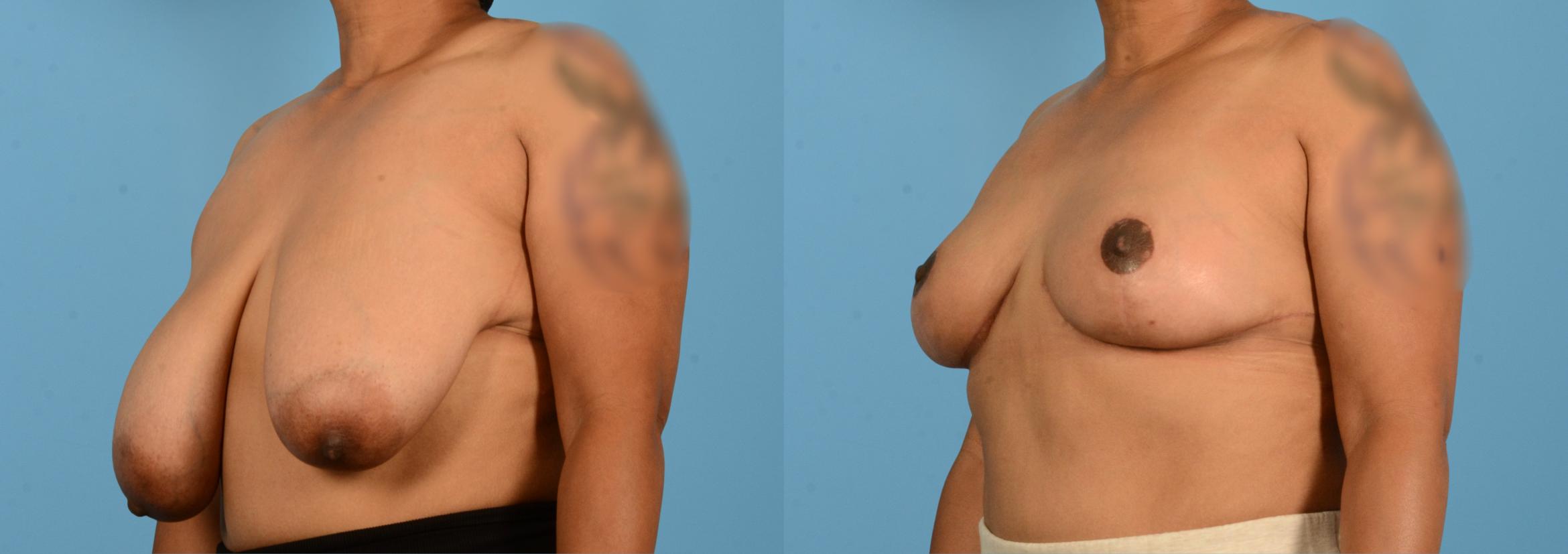 Before & After Breast Lift Case 18135 Left Oblique View in Houston, TX