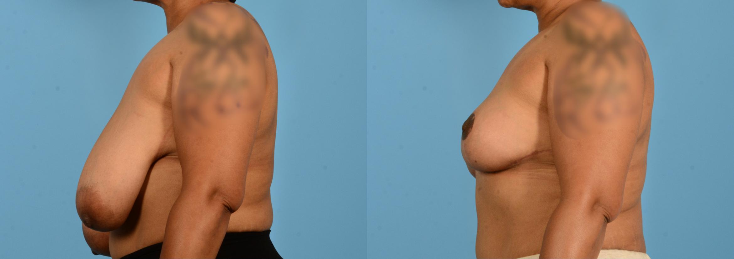 Before & After Breast Lift Case 18135 Left Side View in Houston, TX