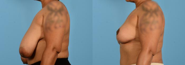 Before & After Breast Lift Case 18135 Left Side View in Houston, TX