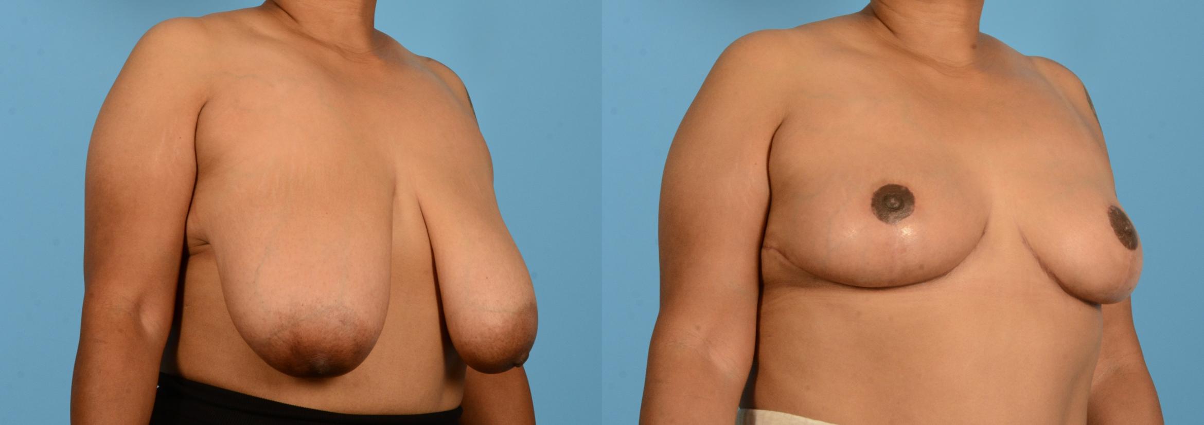 Before & After Breast Lift Case 18135 Right Oblique View in Houston, TX