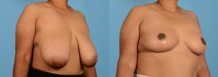 Before & After Breast Lift Case 18135 Right Oblique View in Houston, TX