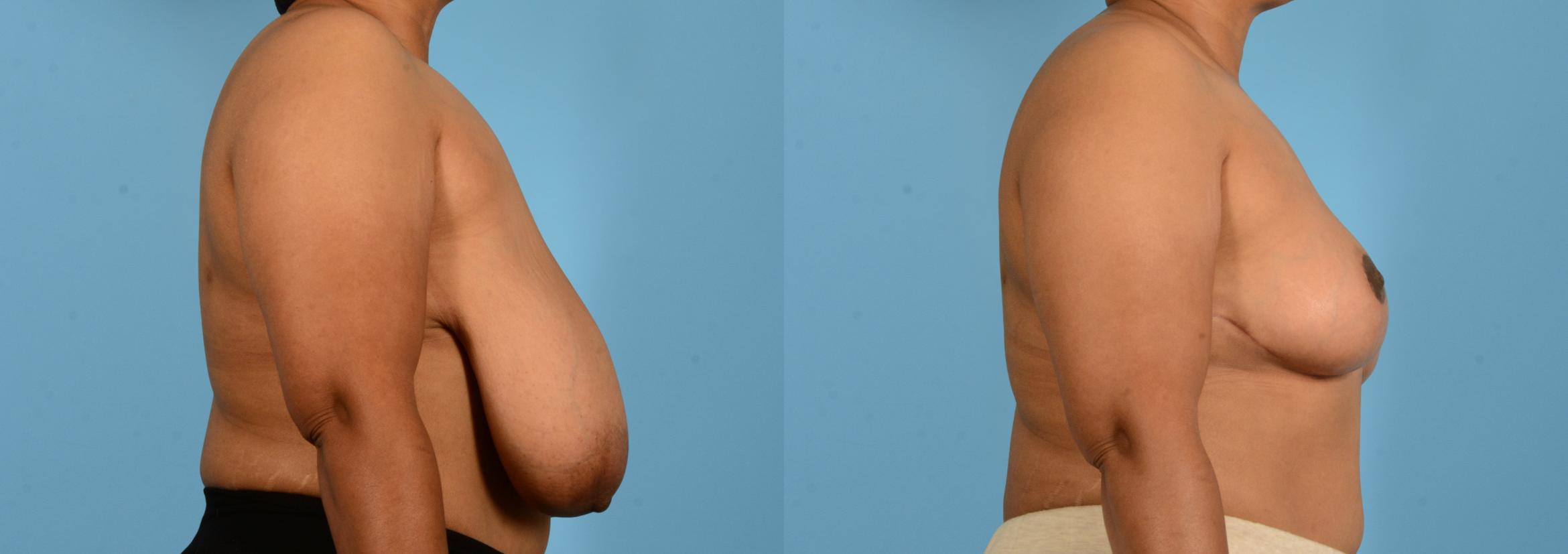 Before & After Breast Lift Case 18135 Right Side View in Houston, TX