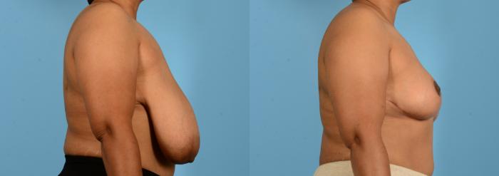 Before & After Breast Lift Case 18135 Right Side View in Houston, TX