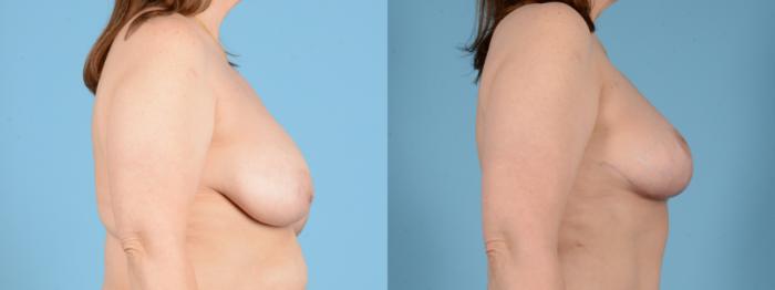 Before & After Breast Lift Case 18141 Right Side View in Houston, TX