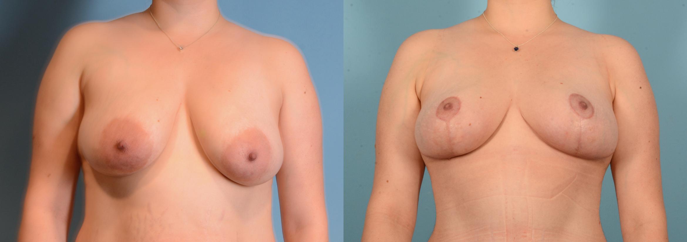 Before & After Breast Lift Case 18158 Front 1 View in Houston, TX