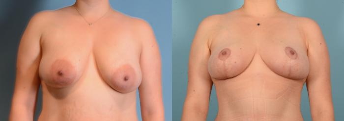 Before & After Breast Lift Case 18158 Front 1 View in Houston, TX