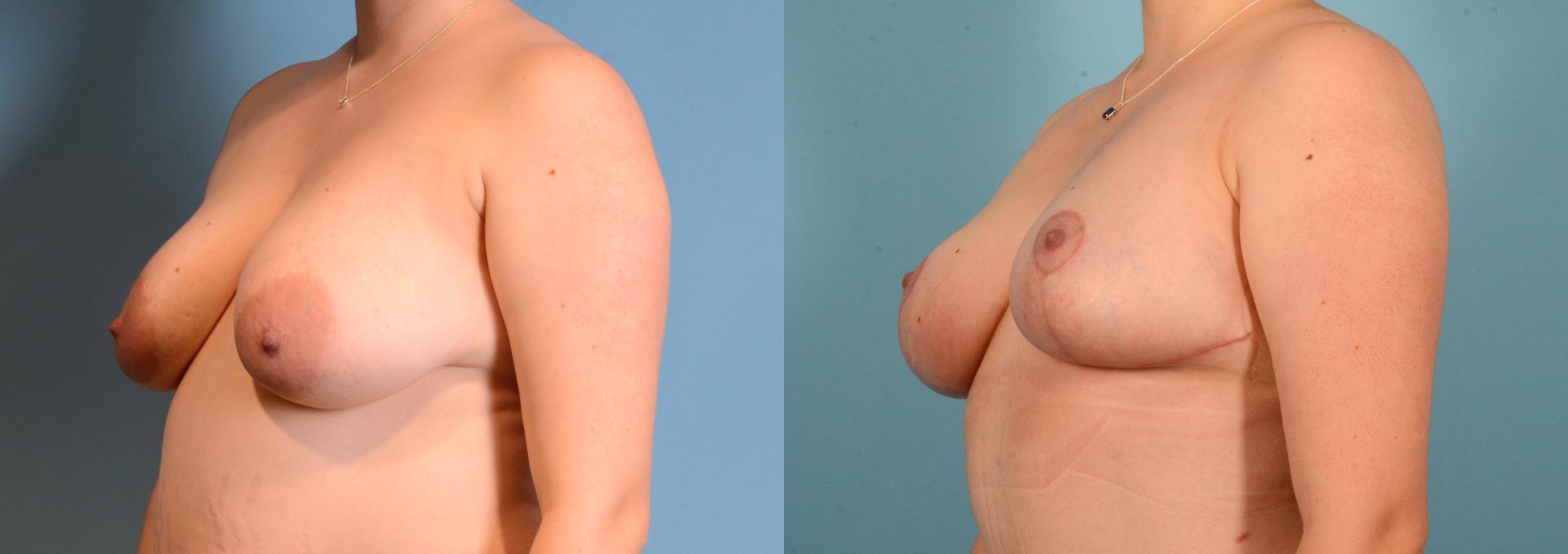 Before & After Breast Lift Case 18158 Left Oblique (Front) View in Houston, TX