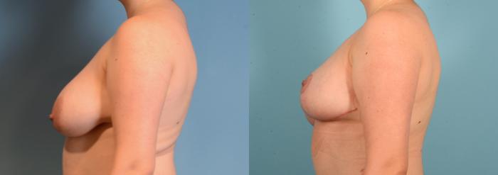 Before & After Breast Lift Case 18158 Left Side View in Houston, TX
