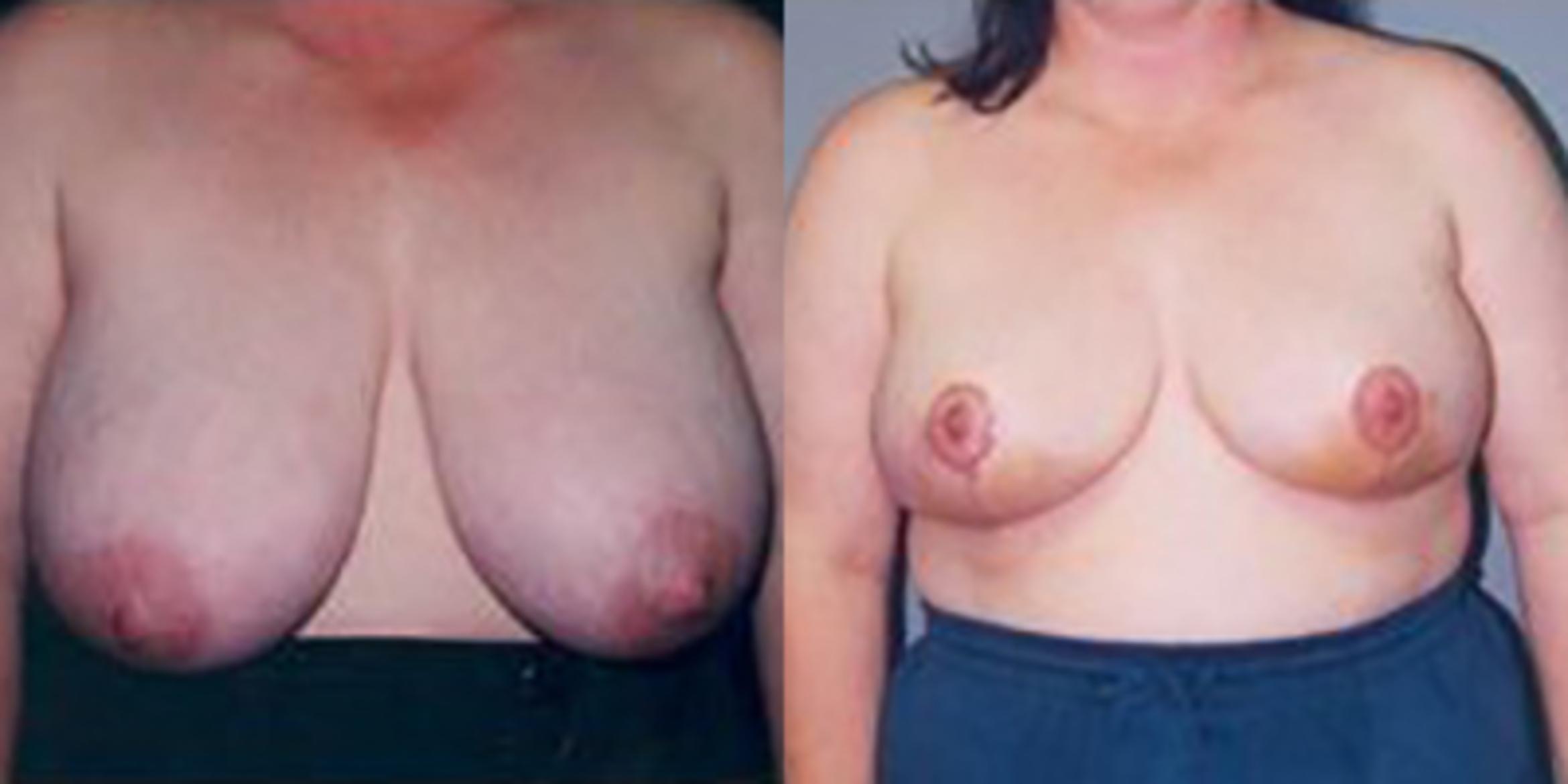 Before & After Breast Reduction Case 4576 View 1 View in Houston, TX