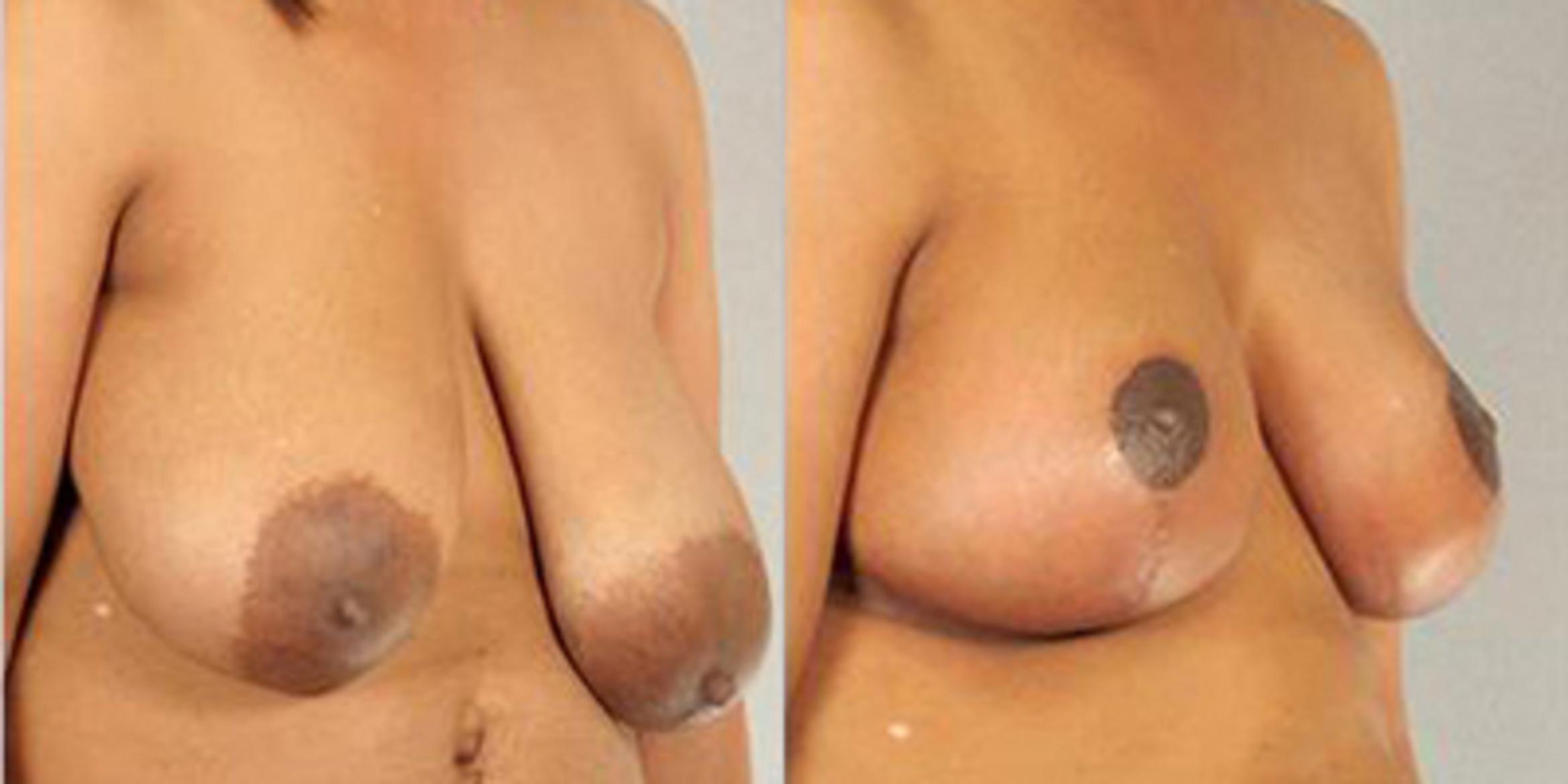 Before & After Breast Reduction Case 4580 View 2 View in Houston, TX