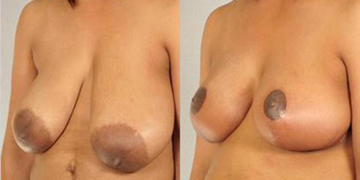 Before & After Breast Reduction Case 4580 View 3 View in Houston, TX
