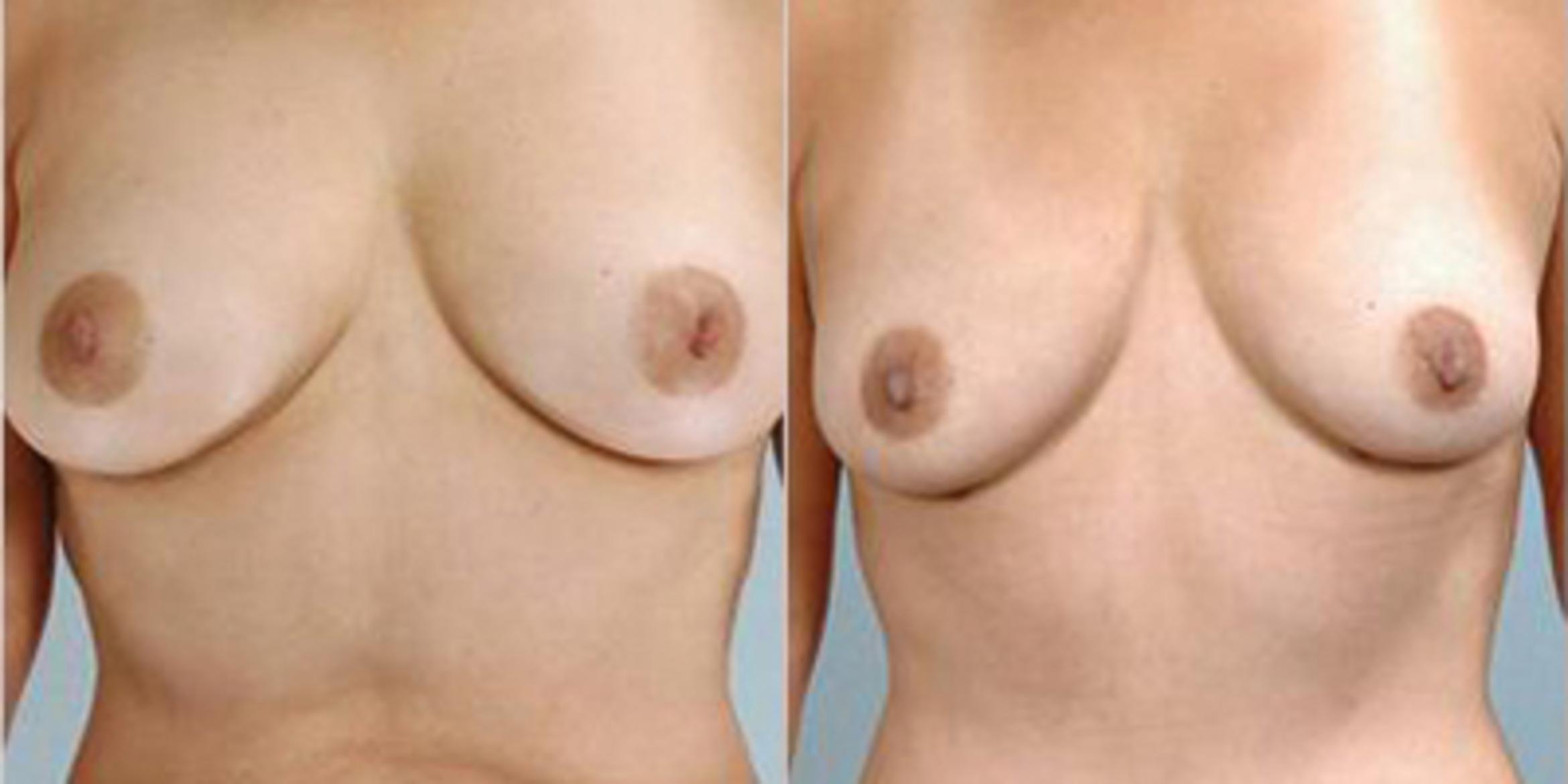 Before & After Breast Reduction Case 4594 View 1 View in Houston, TX