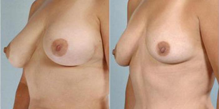 Before & After Breast Reduction Case 4594 View 2 View in Houston, TX
