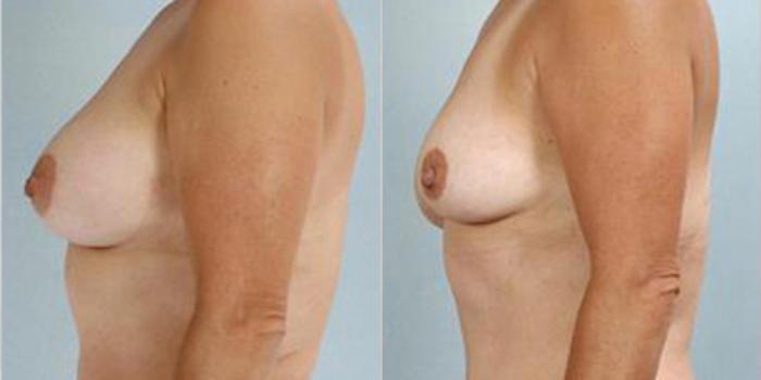 Before & After Breast Reduction Case 4594 View 3 View in Houston, TX