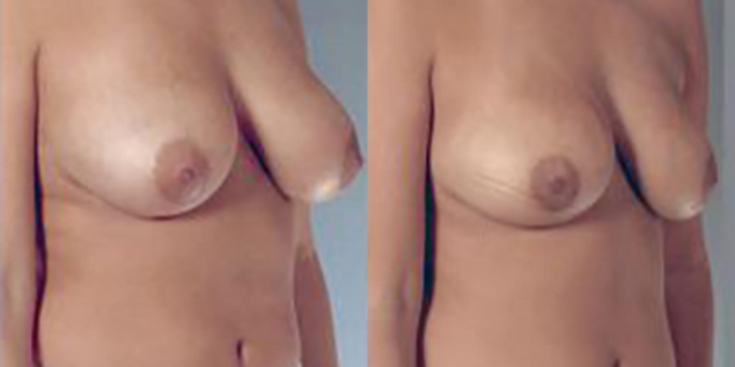 Before & After Breast Reduction Case 4609 View 2 View in Houston, TX