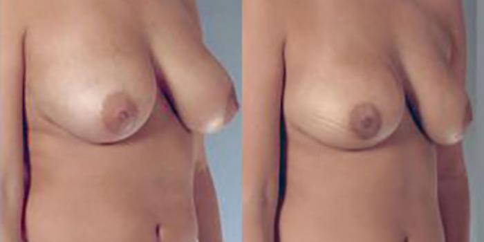 Before & After Breast Reduction Case 4609 View 2 View in Houston, TX