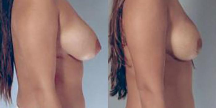 Before & After Breast Reduction Case 4609 View 3 View in Houston, TX