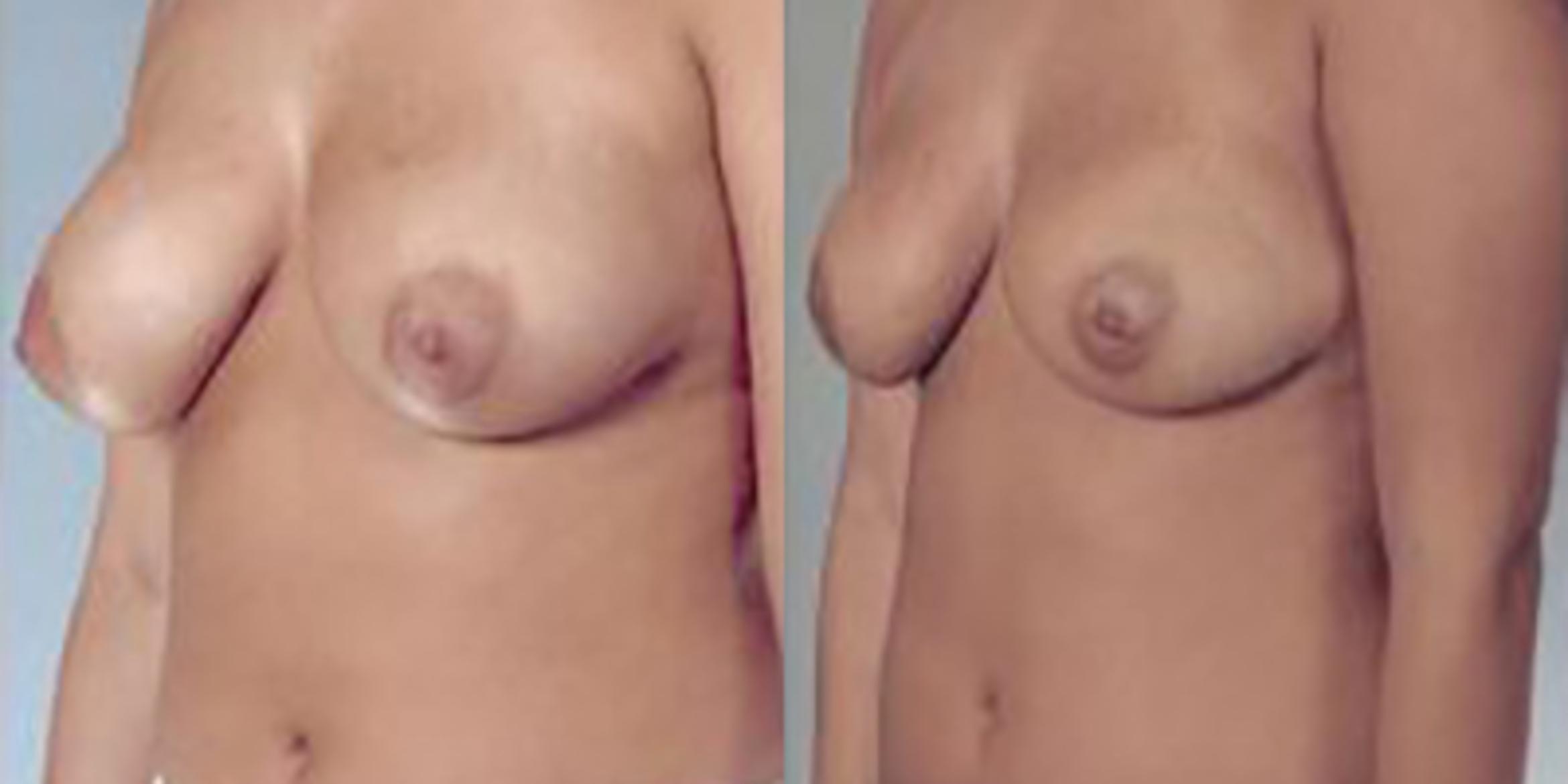 Before & After Breast Reduction Case 4609 View 4 View in Houston, TX