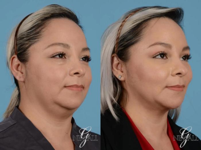 Before & After Buccal Fat Removal Case 17452 View 2 View in Houston, TX