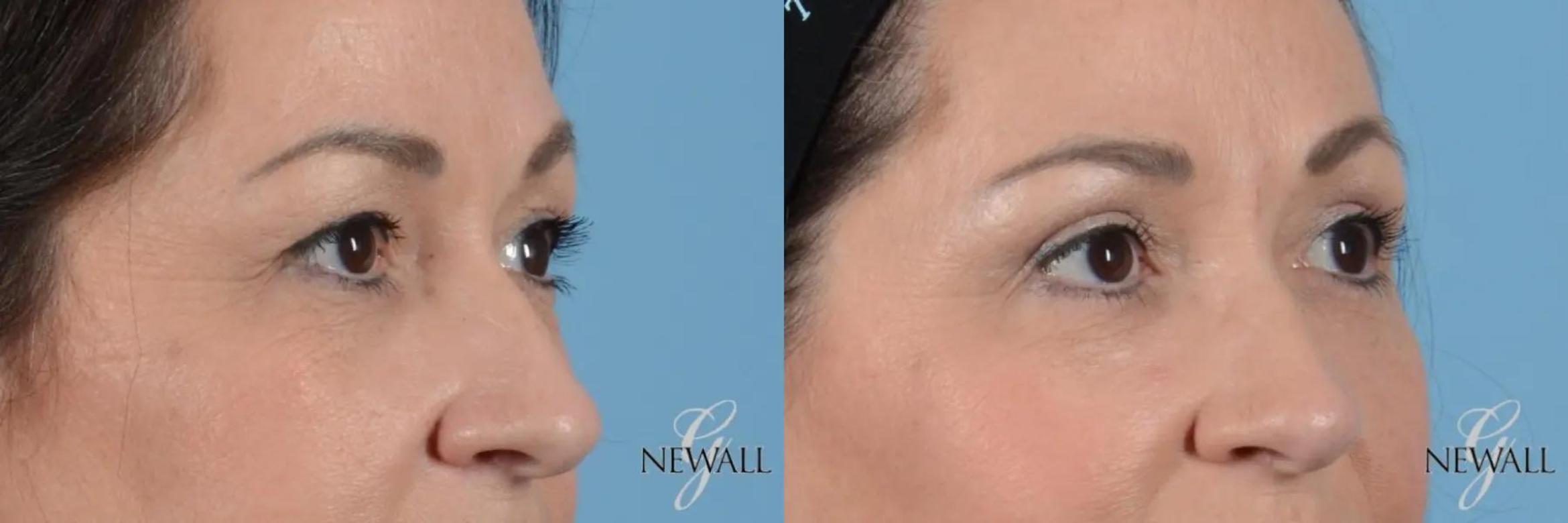 Before & After Eyelid Lift Case 17020 View 2 View in Houston, TX