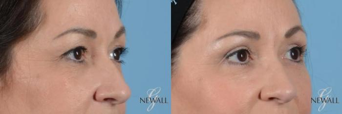 Before & After Eyelid Lift Case 17020 View 2 View in Houston, TX