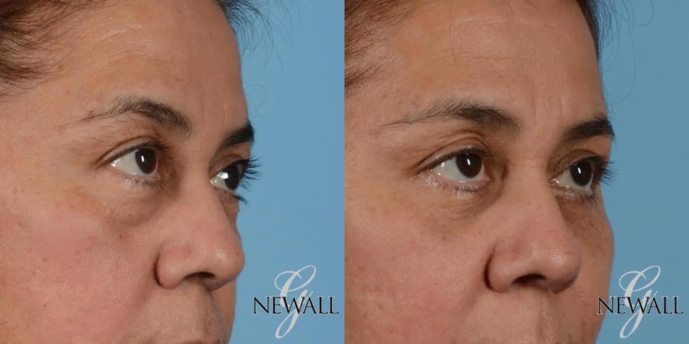 Before & After Eyelid Lift Case 17563 View 2 View in Houston, TX