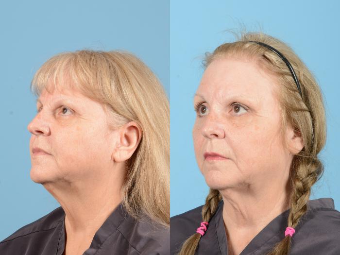 Before & After Eyelid Lift Case 18157 Left Oblique (Front) View in Houston, TX