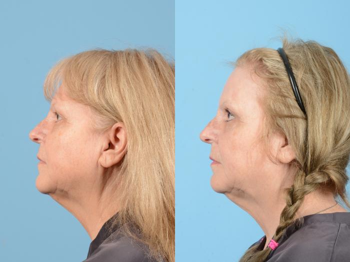 Before & After Eyelid Lift Case 18157 Left Side View in Houston, TX