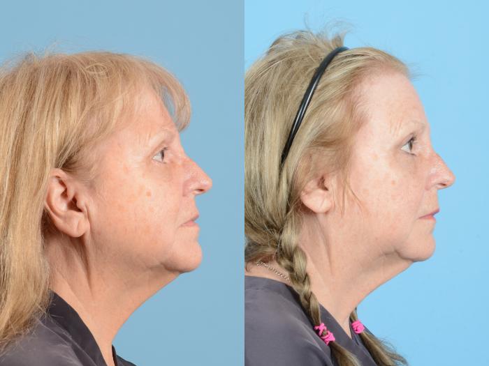 Before & After Eyelid Lift Case 18157 Right Side View in Houston, TX