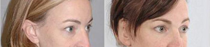 Before & After Eyelid Lift Case 217 View 2 View in Houston, TX
