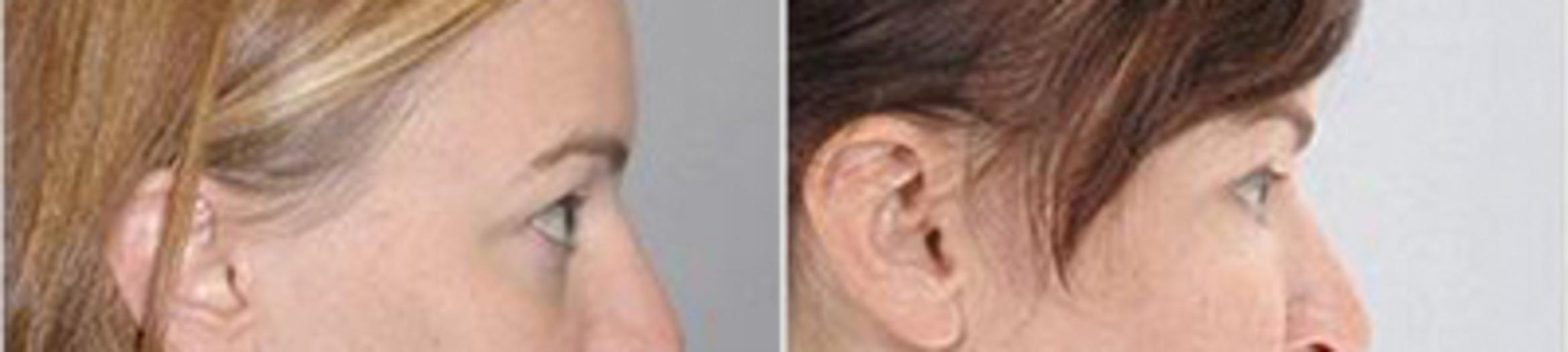 Before & After Eyelid Lift Case 217 View 3 View in Houston, TX